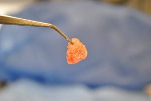 example of Platelet Rich Fibrin