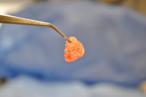 example of Platelet Rich Fibrin